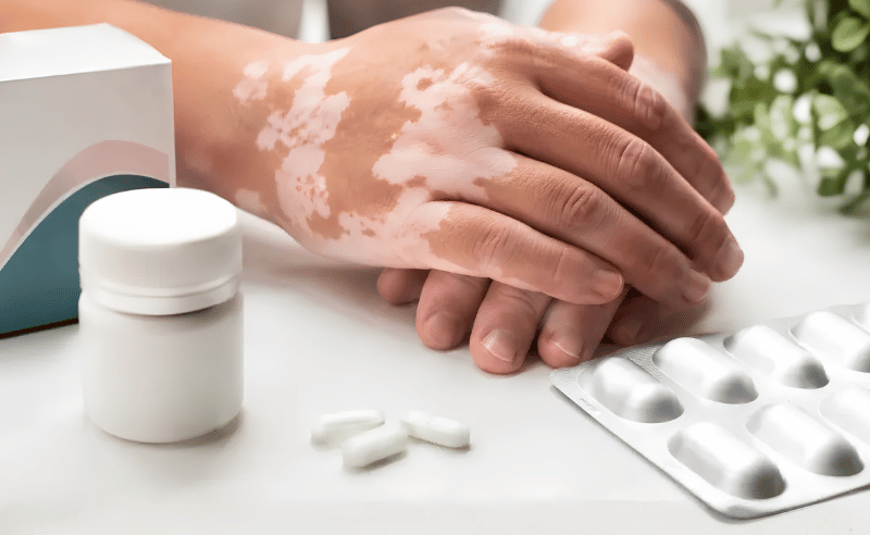 First Oral Treatment for Non-Segmental Vitiligo Approved in UAE
